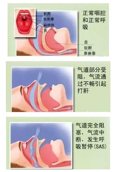 呼吸機可以完全治愈睡眠呼吸暫停嗎？